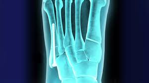 Fracture Fixation