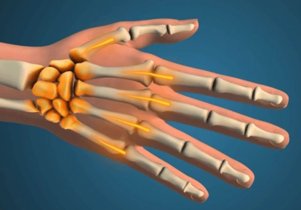 1 Fractures & Dislocations in Hand