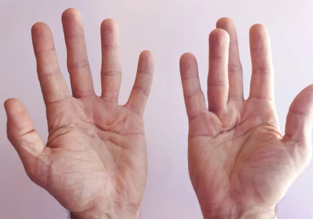 10 Dupuyterans Contracture