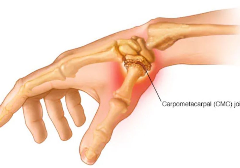 17 Thumb Basal arthritis