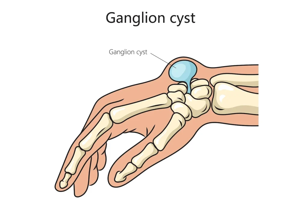 1800x1200_ganglion_cyst_bigbead