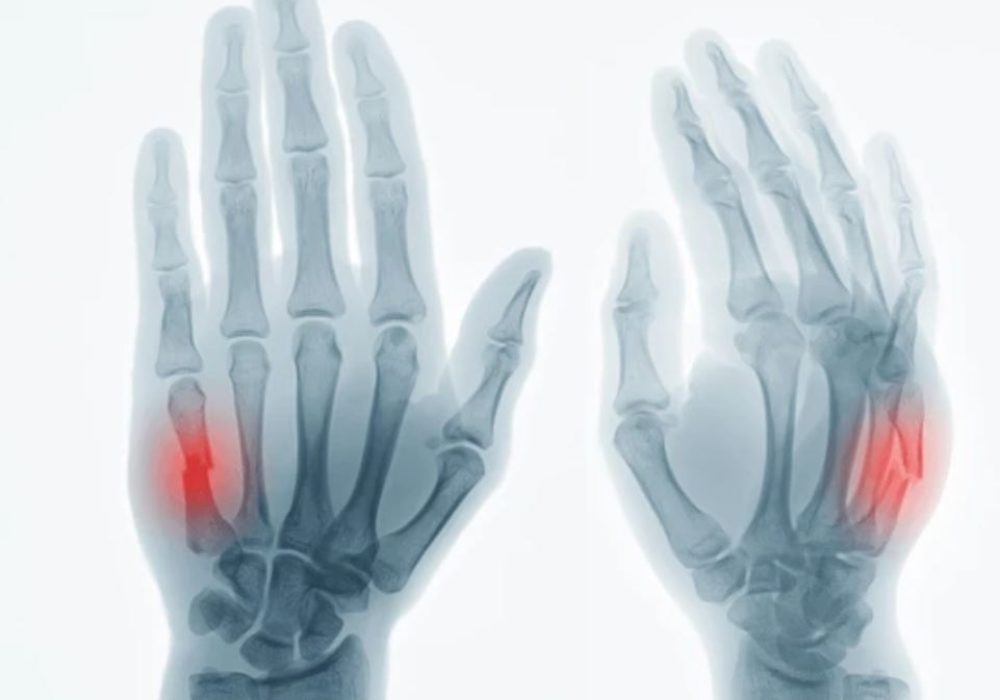 2 Metacarpal & Phalanx Fracture