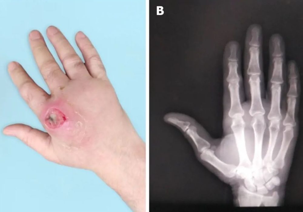 20 Septic arthritis Hand