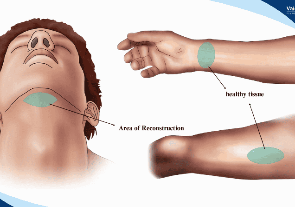 2025-01-03Microvascular Free Flap Reconstruction Surgery for Head and Neck Cancer Treatment - Intro