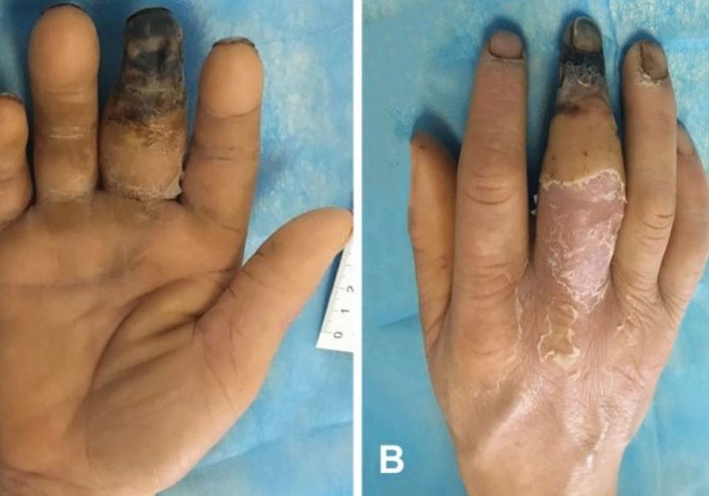 21 Diabetic Hand Infections