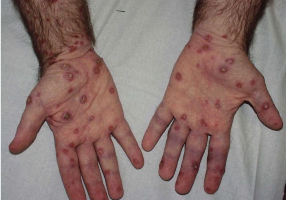 22 Atypical Hand infections