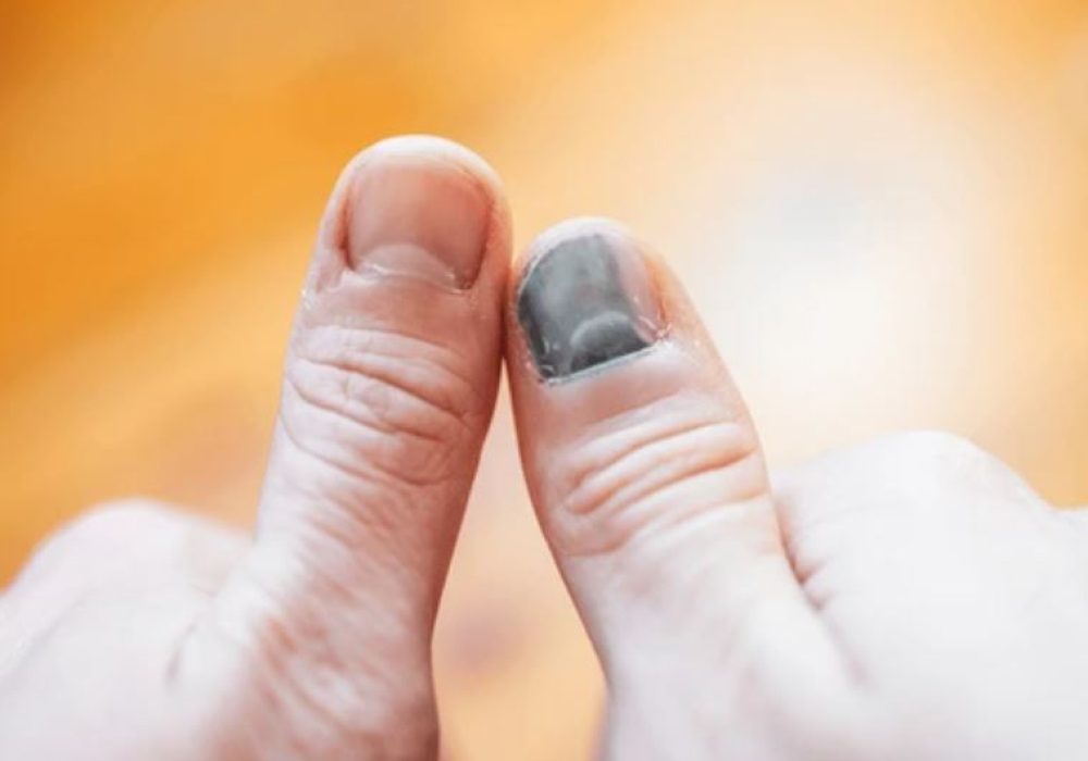 23 Subungual Hematoma