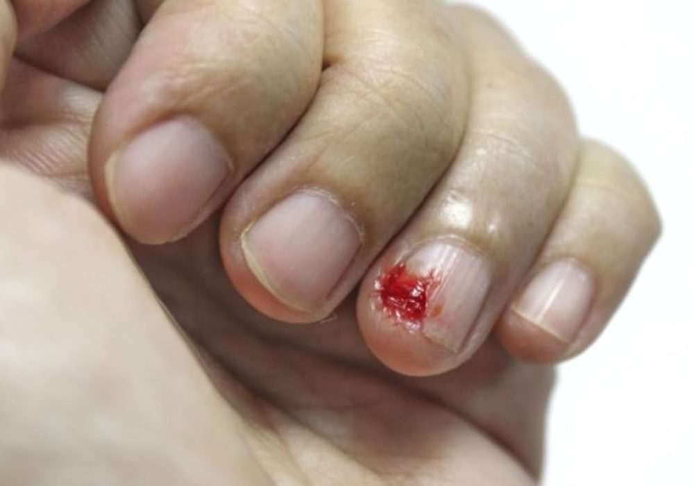 24 nail bed injury