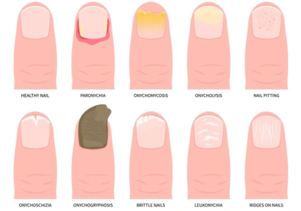 25 nail deformities