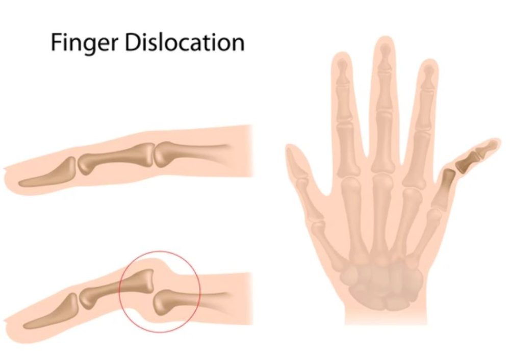 4 Finger Dislocation