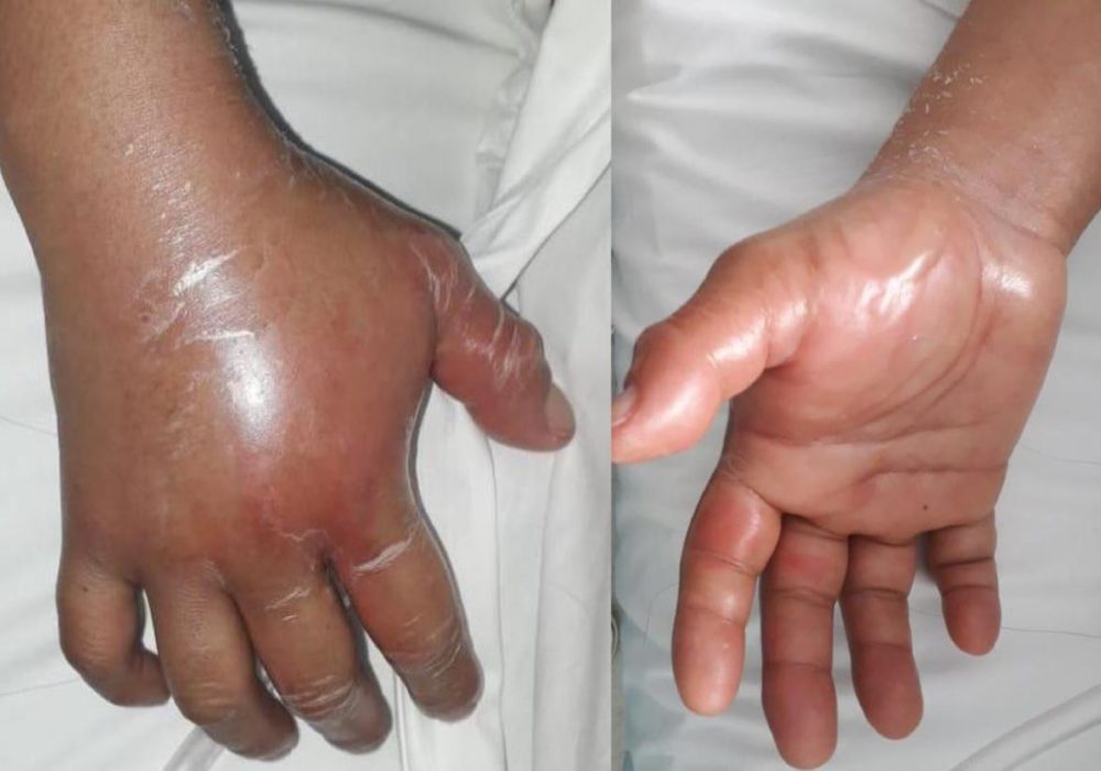 6 Compartment Syndrome