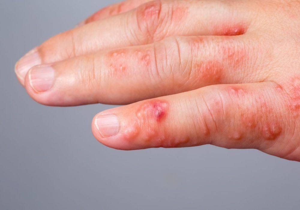 Acute Infections of Hand