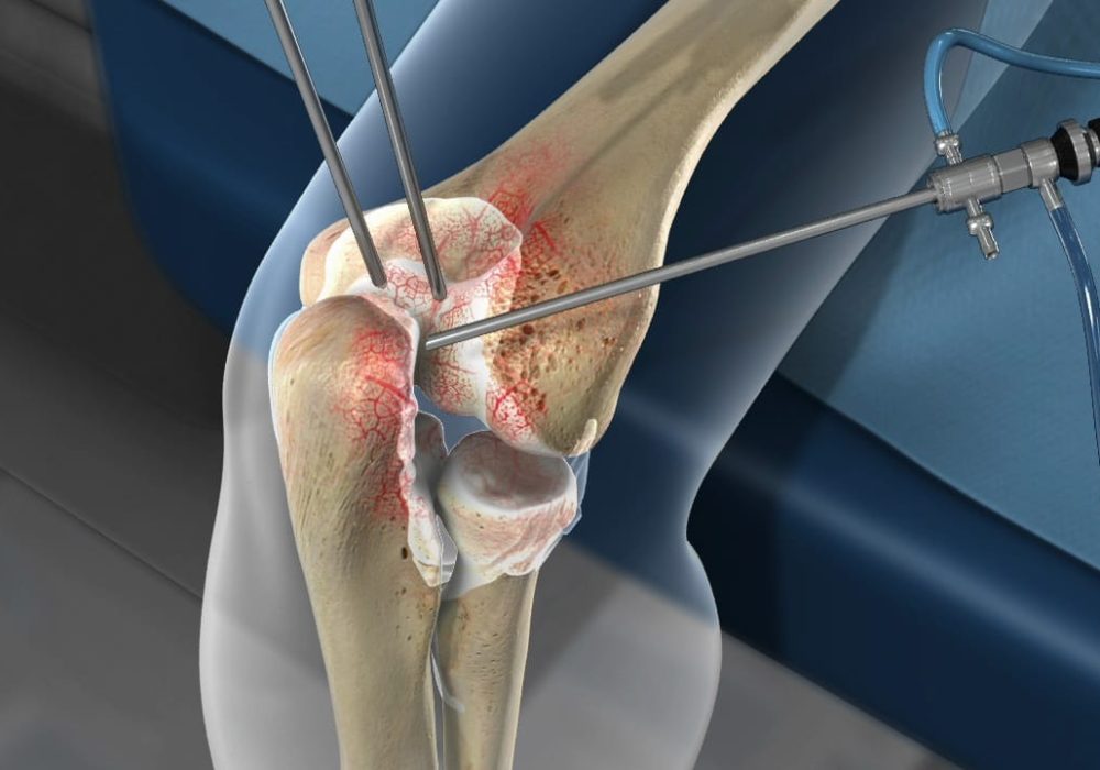 Arthroscopic Tennis elbow release