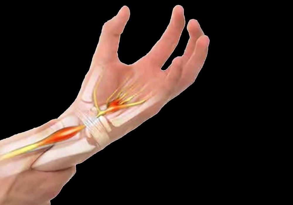 Carpal Tunnel Syndrome
