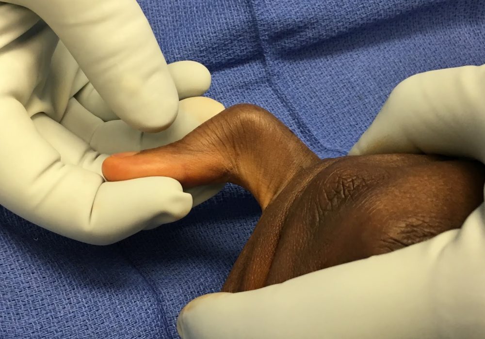 Clinodactyly (Bent Finger)