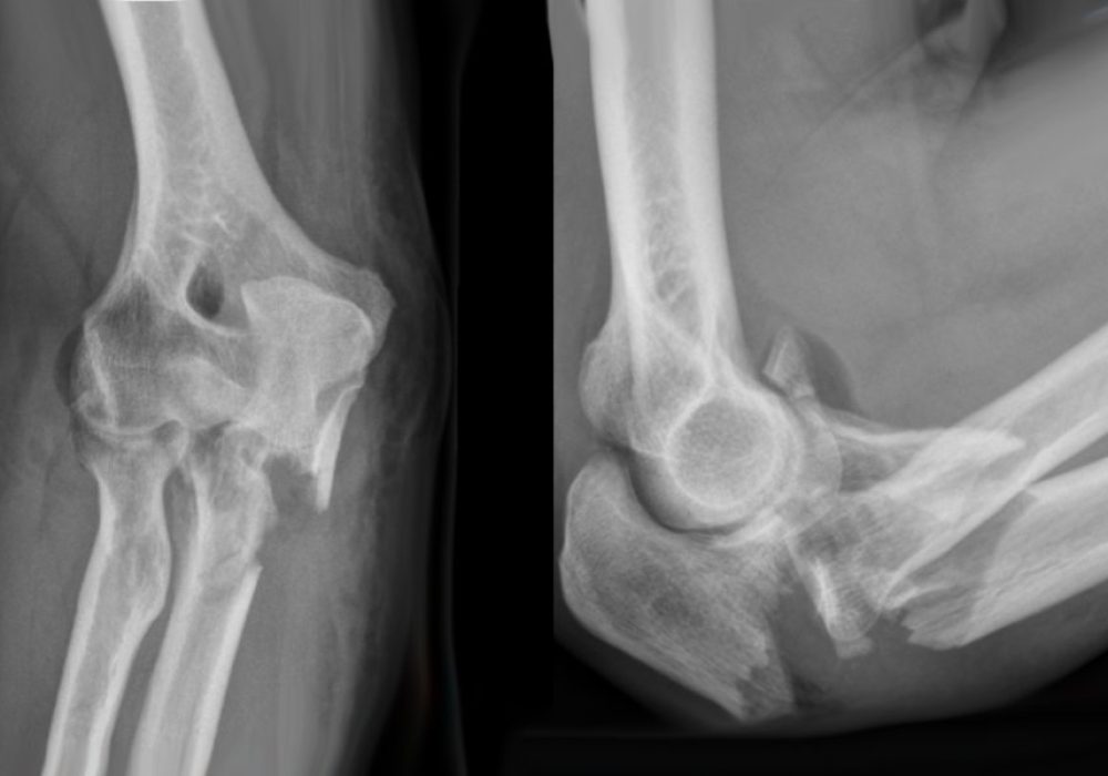Complex Elbow Fracture fixation