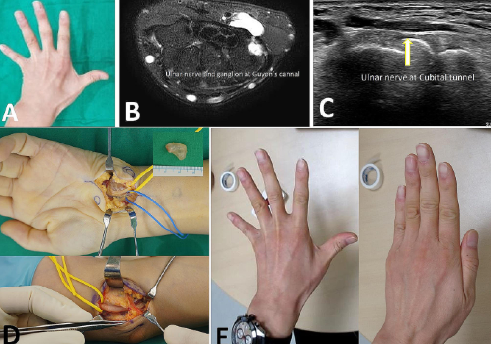 Crush Injuries of Hand & Upper limb