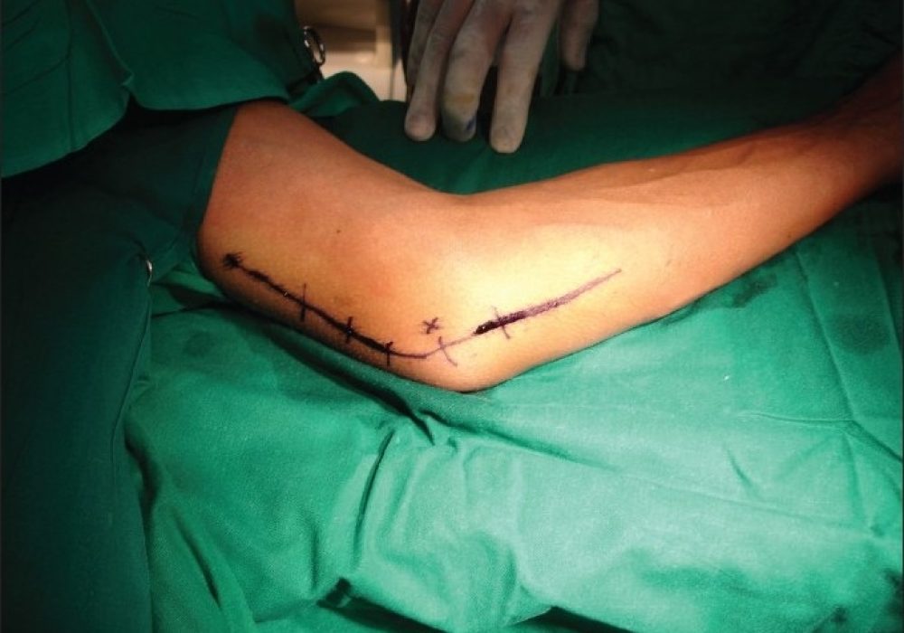 Cubital Tunnel Release Surgery