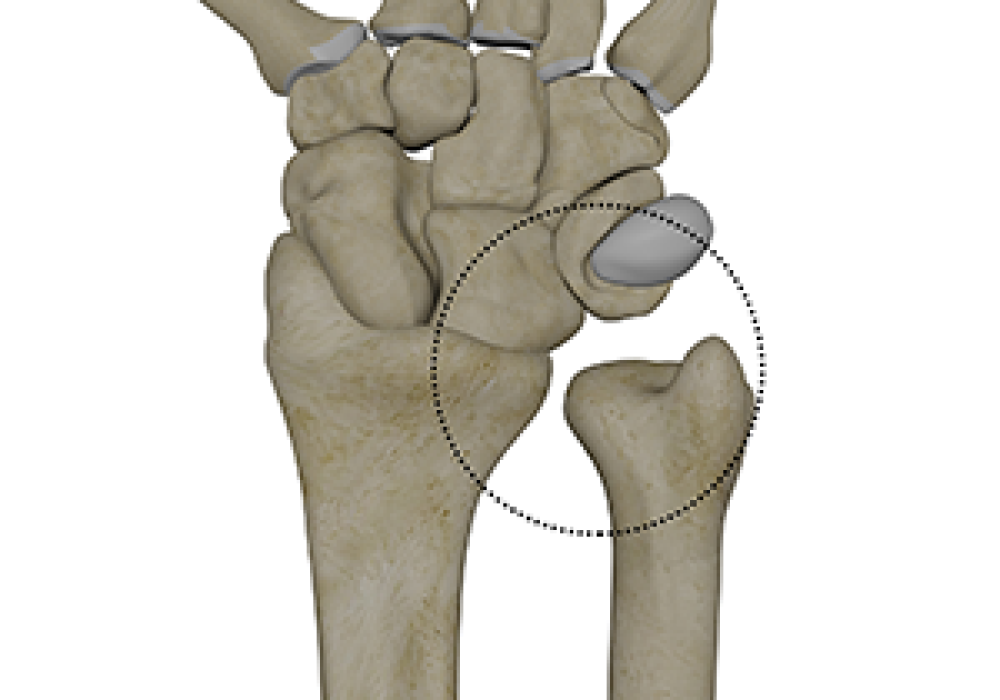 DRUJ Instability & Dislocation