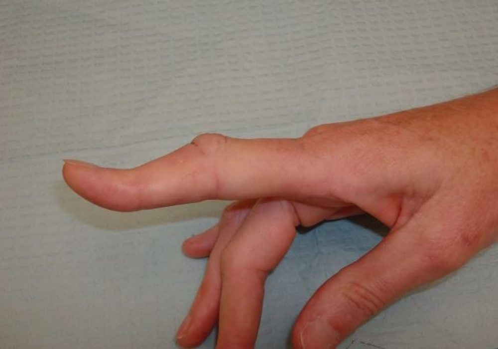 Dislocations of Finger Joints