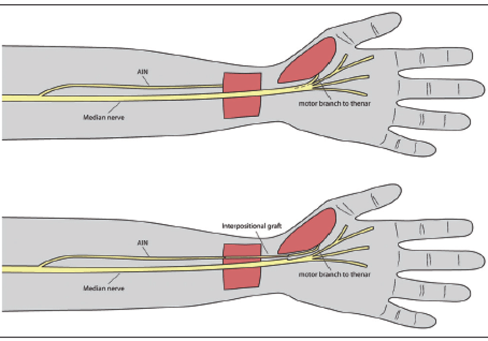 Distal-median-nerve-deficit-Transfer-of-the-terminal-branch-of-the-anterior-interosseous