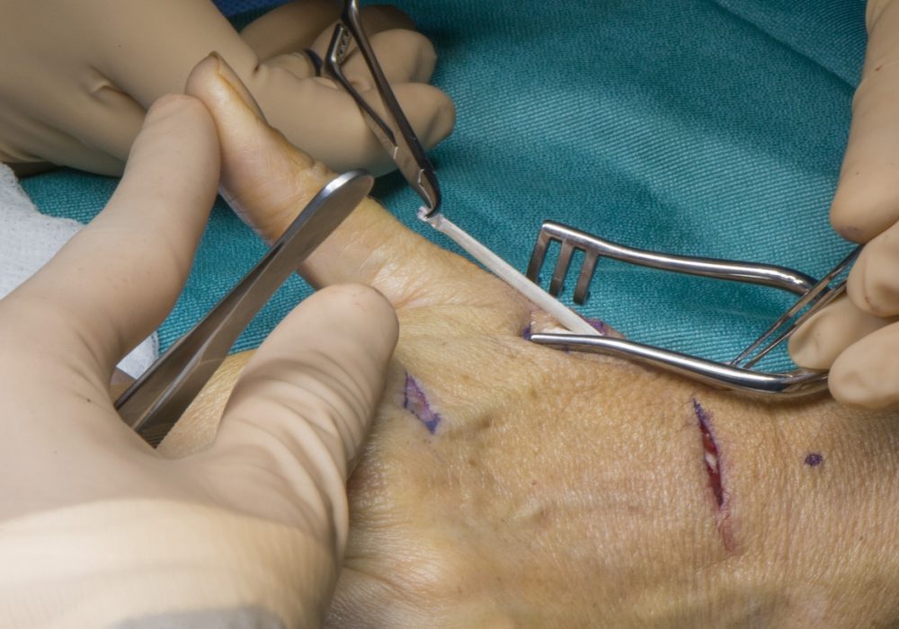 EIP to EPL transfer (Tendon Surgery)