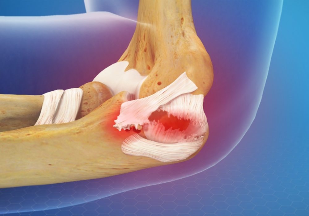 Elbow Multi Ligament Reconstruction