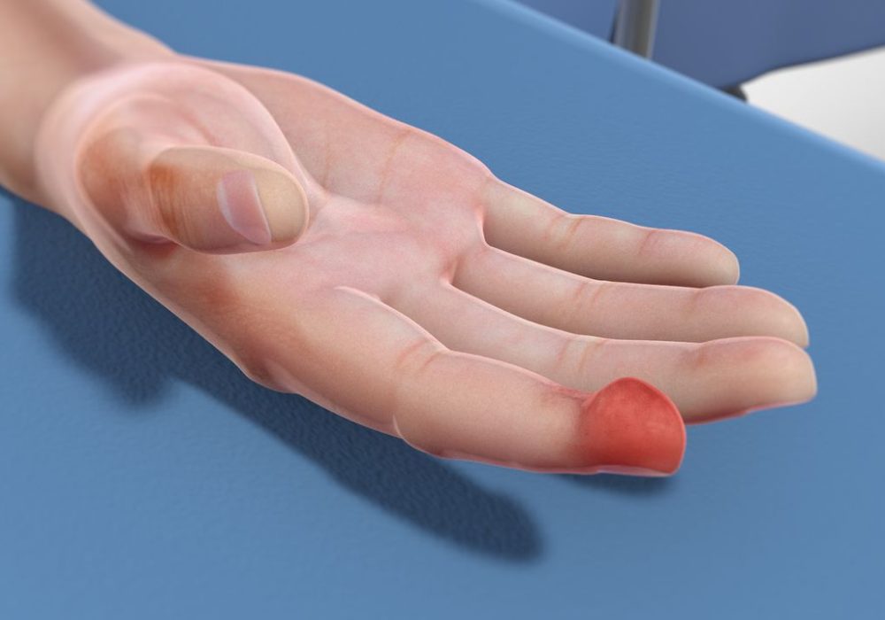 Finger Pulp Infection (Felon)