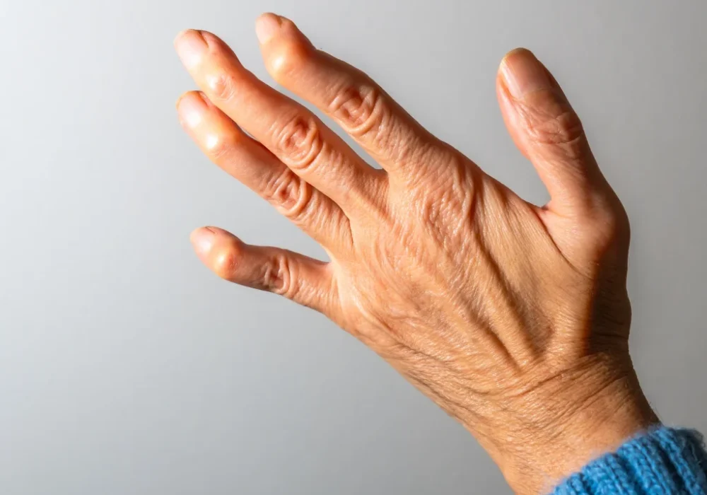 Finger_Derformities-1024x858