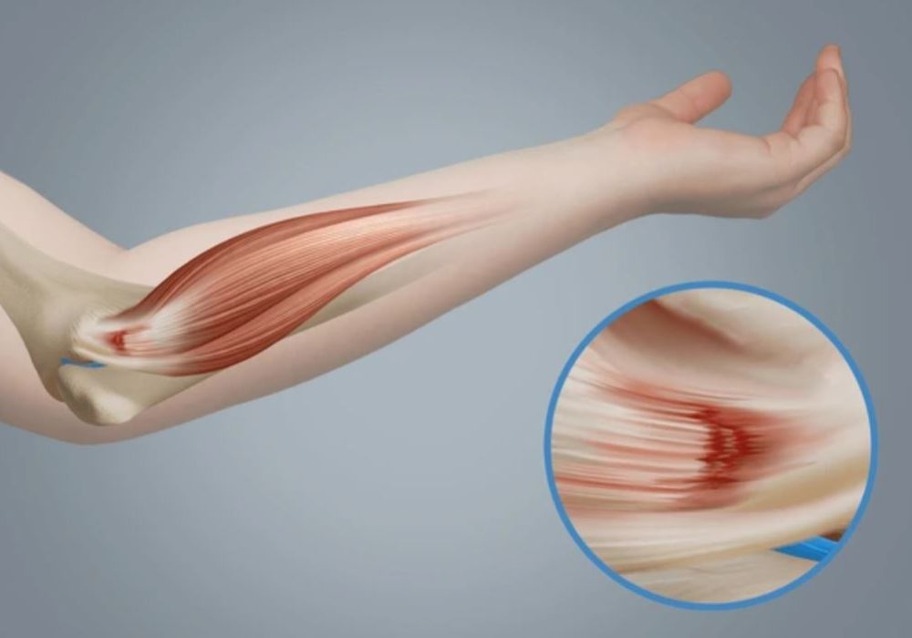 Golfers elbow