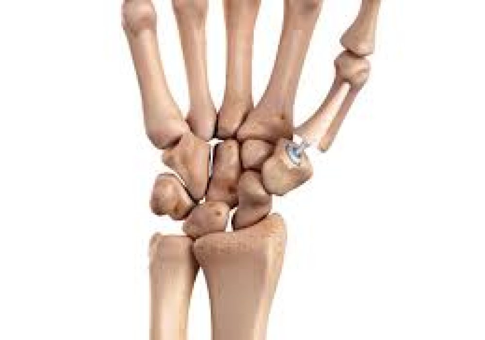 Joint Replacement in Hand