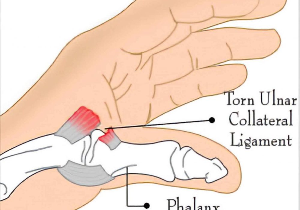 Ligamentous Injuries of Fingers and Thumb