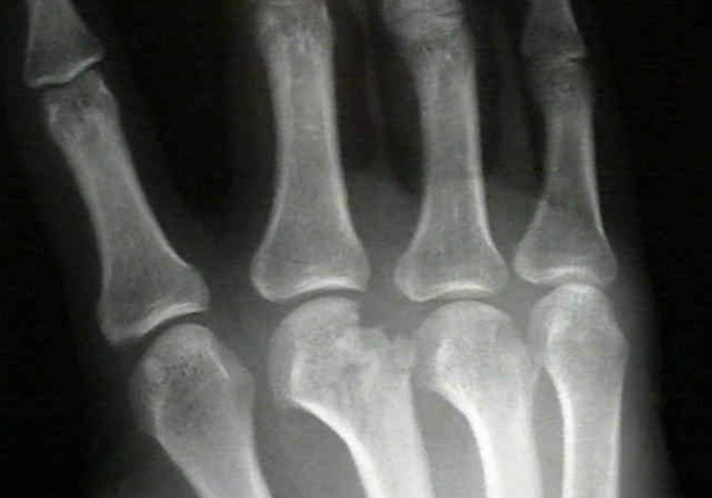 Metacarpal & Phalangeal fractures