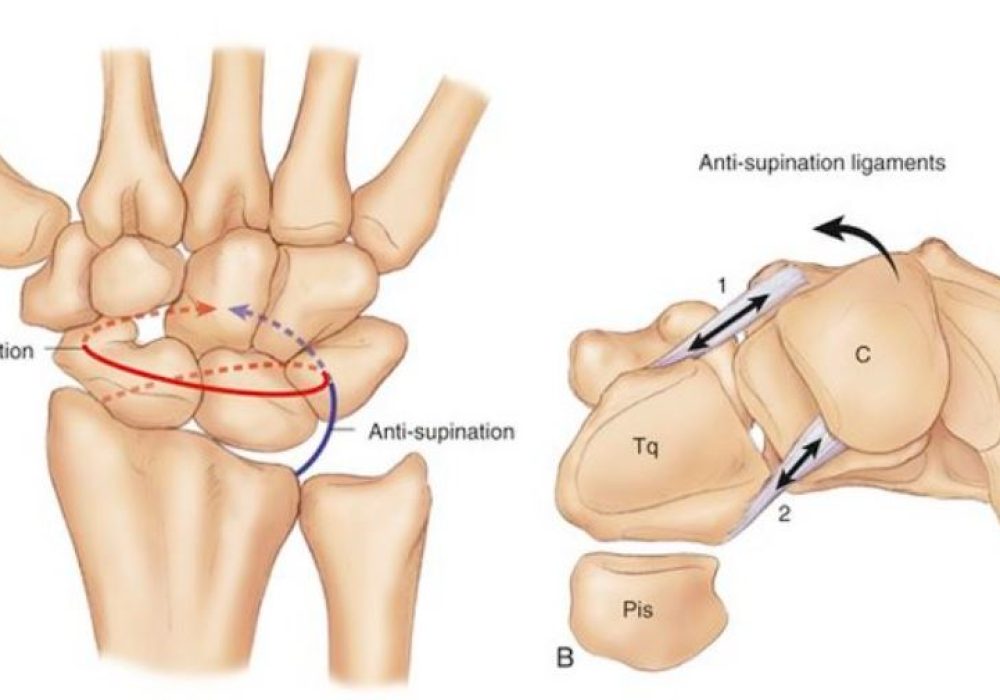 Midcarpal instability