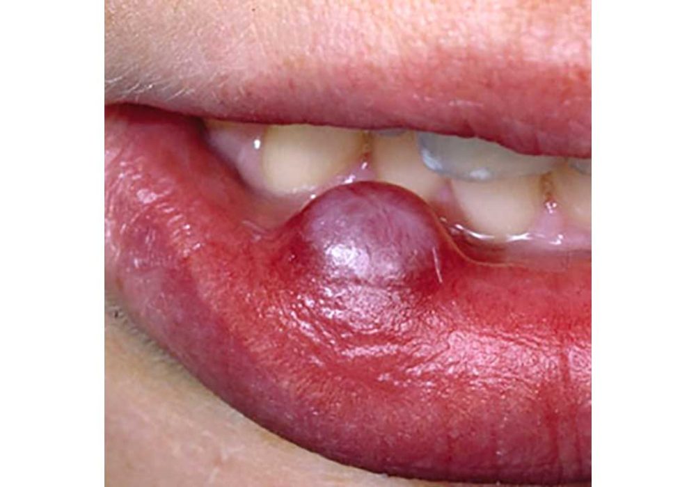Mucous Cyst