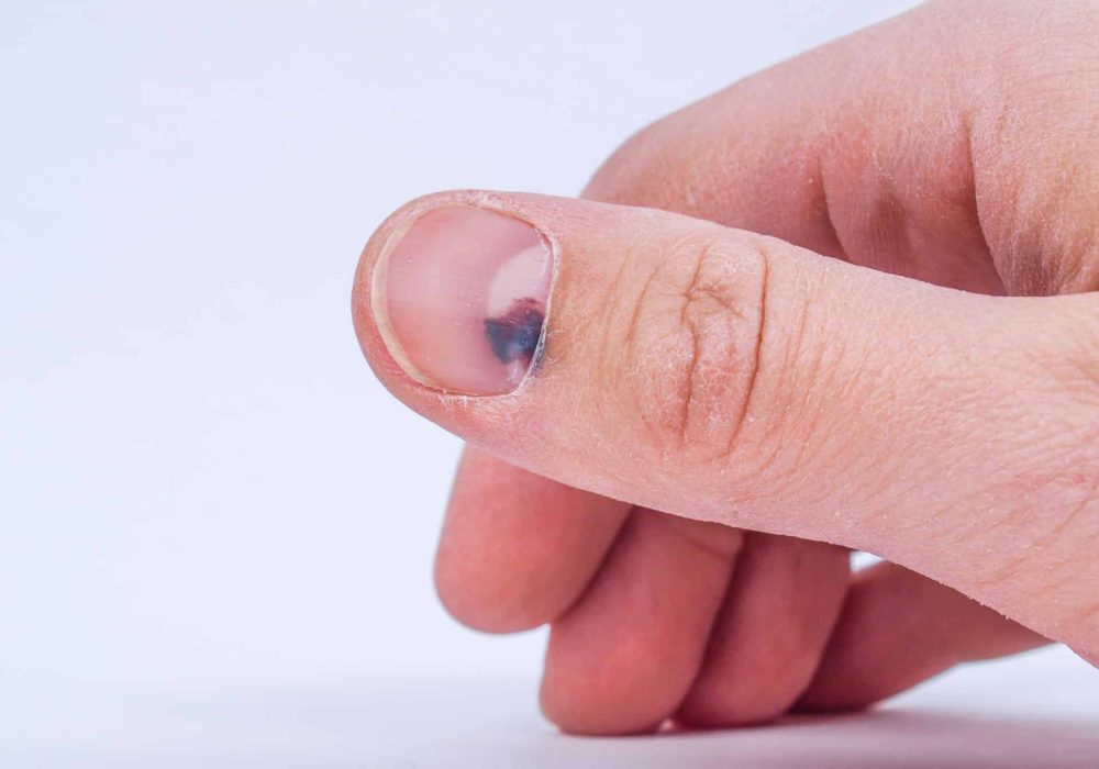 Nail Bed and Soft Tissue Repair