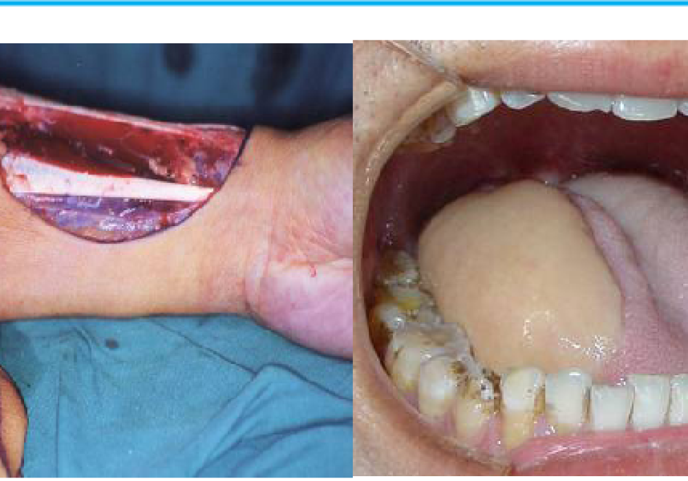 Non Microvascular flaps