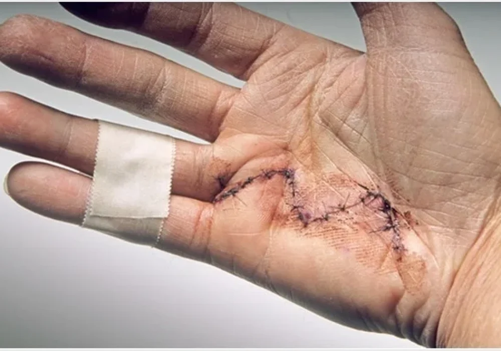 Pediatric Contracture Release