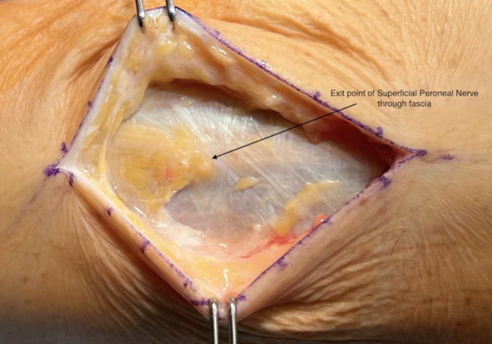 Peroneal Nerve Compression