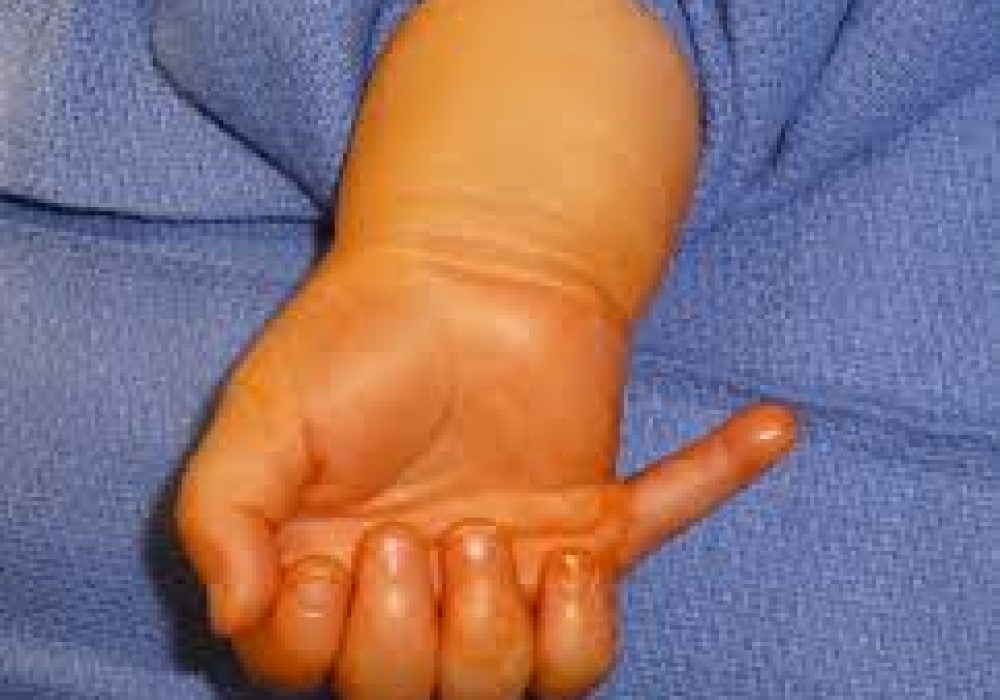 Polydactyly (Extra Digits)