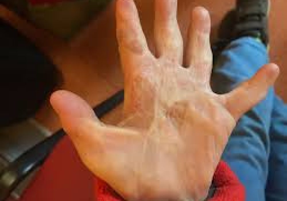 Post Burn Contractures of Fingers