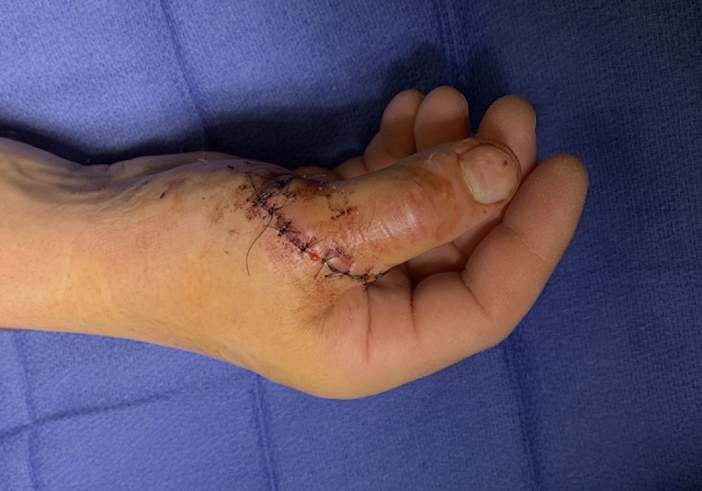 Primary Extensor Tendon Repair