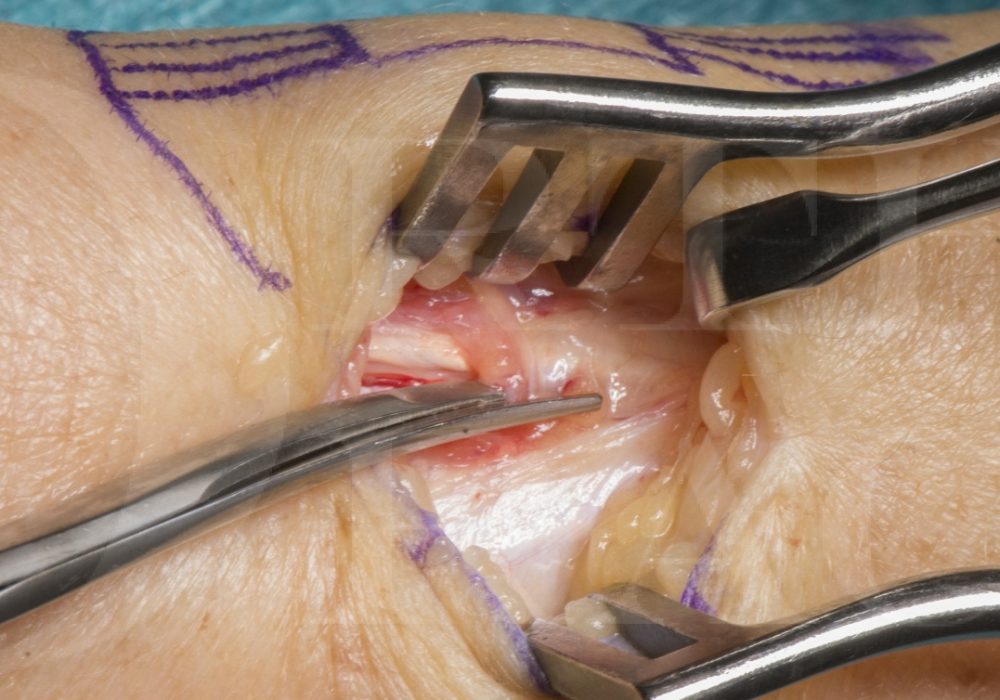 ROH_De-Quervains-Release_Mark-Brewster_24.07.2018-14-e1535311579219-1077x870