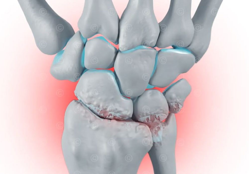 Radiocarpal Arthritis