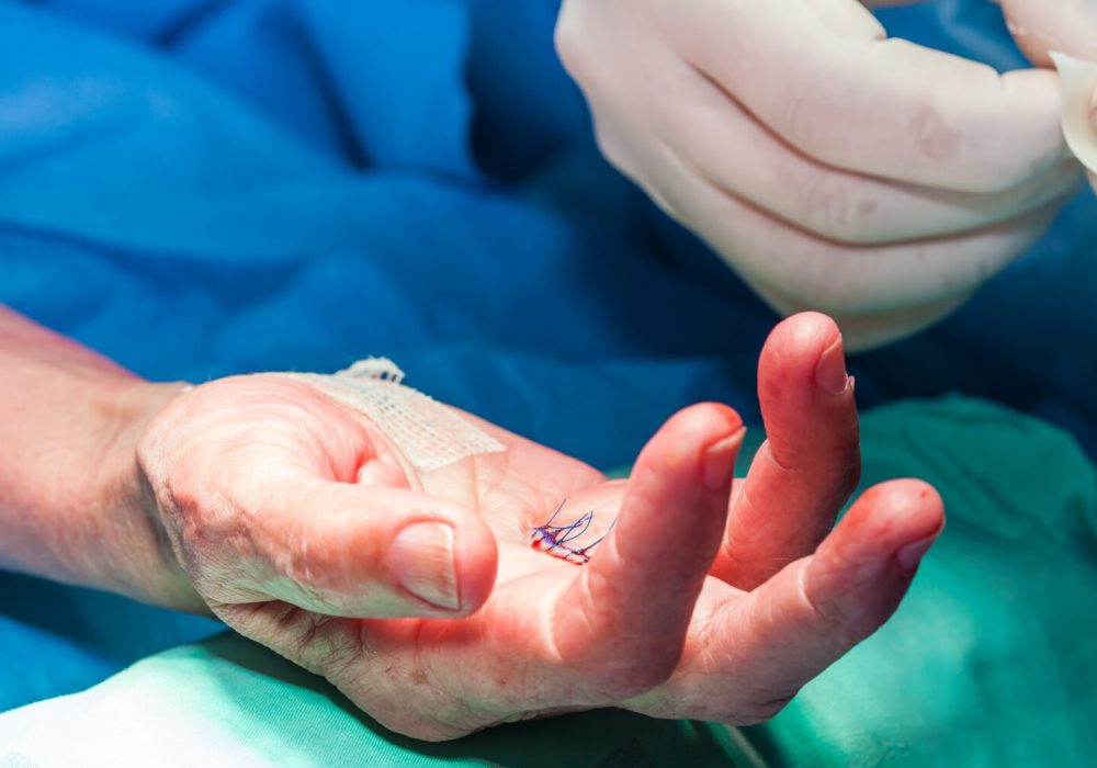 Reconstructive Hand Surgery