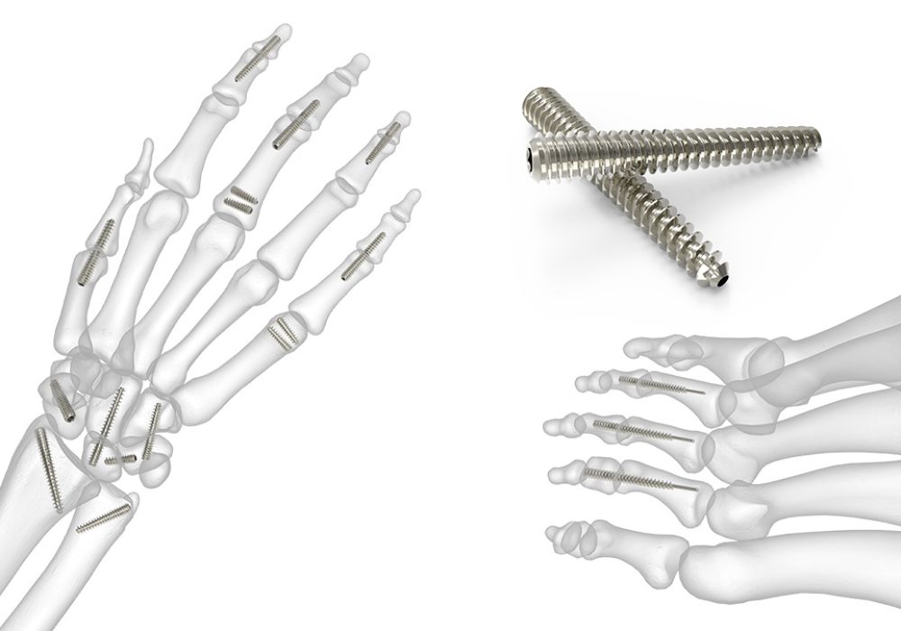 SP-Acutrak-Headless-Compression-Screw-System-Hero