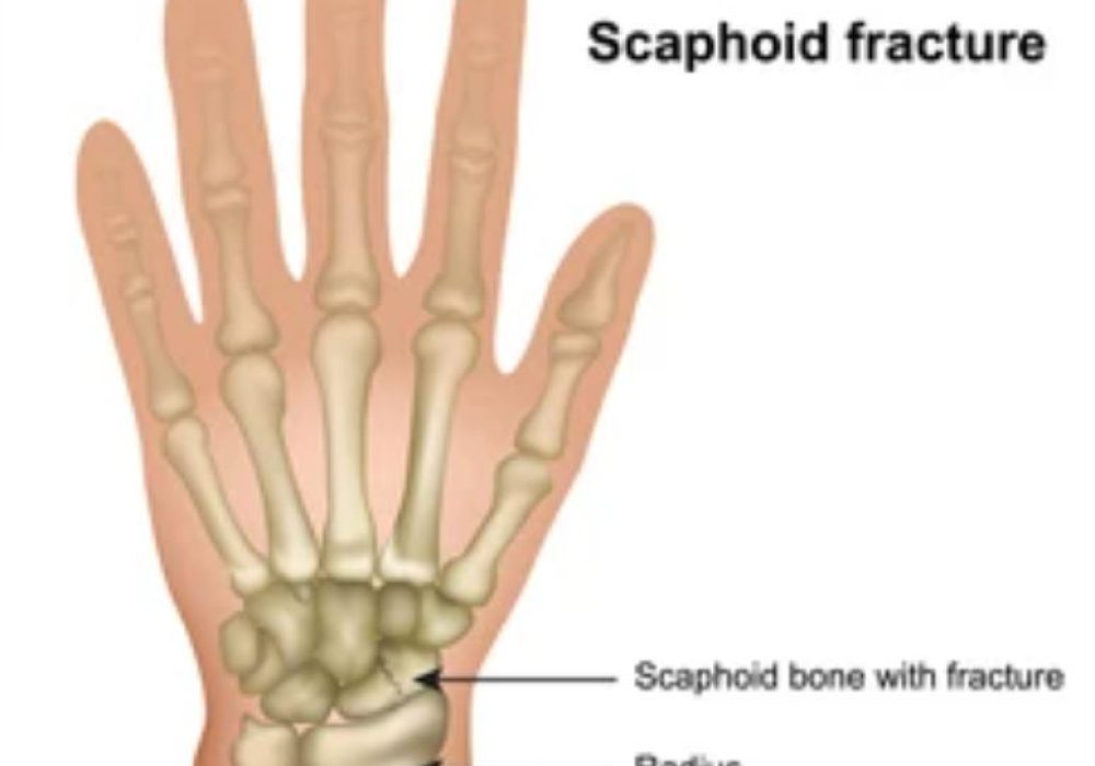 Scaphoid Fractures