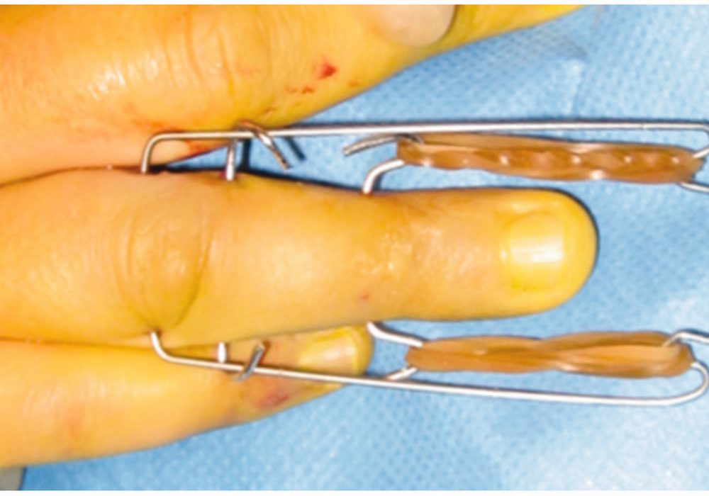 Suzuki Frame / Ex-Fixator