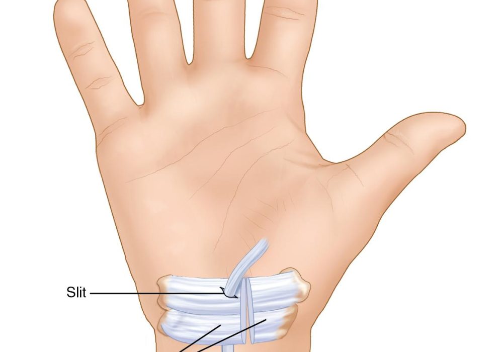 Tendon Transfers