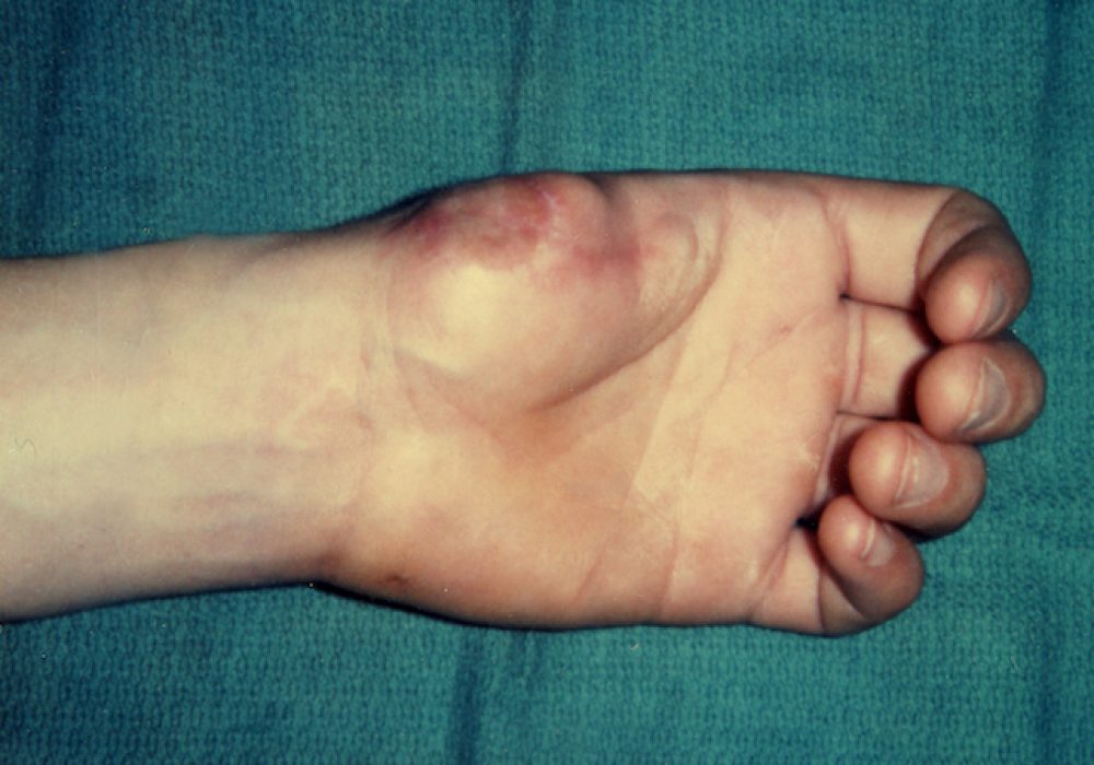 Thumb PollizationFailed Replant